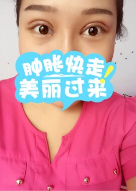 終于把雙眼皮割了，無錫菲尚張樹功做的