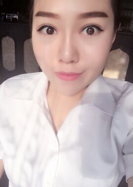 終于把雙眼皮割了，無錫菲尚張樹功做的