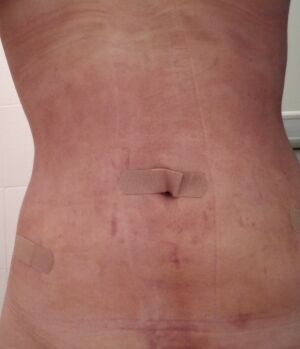 腰腹吸脂后腰線好看太多，肚子也小了