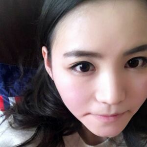 埋埋蛋白線.提升后臉上變得緊致許多，輪廓變得更好看