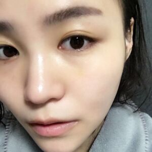 埋埋蛋白線.提升后臉上變得緊致許多，輪廓變得更好看