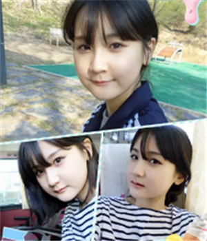 做了磨下頜角整形手術(shù)4個月了，曬曬我的恢復(fù)前后的對比照片吧~~