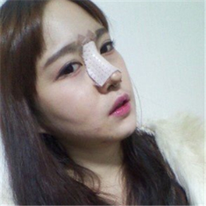 分享我改臉型+硅膠隆鼻手術(shù)前后對比果照片，伊萊美李湘源做的~