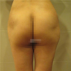 做了自體脂肪移植豐胸手術(shù)，勾勒出**胸部曲線，看看果照片~~