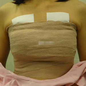 做了自體脂肪移植豐胸手術(shù)，勾勒出**胸部曲線，看看果照片~~