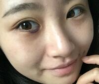 內(nèi)切去眼袋價(jià)格2180元，祛眼袋前后對(duì)比圖分享給大家