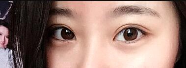 祛眼袋手術(shù)價格分享