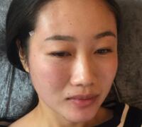 自體脂肪面部填充價(jià)格12800元案例