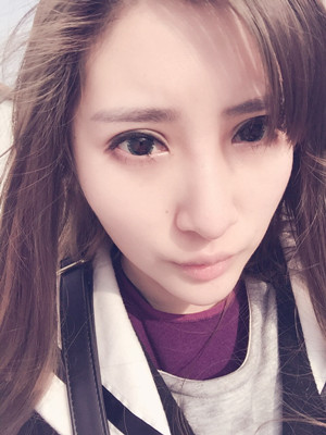 玻尿酸隆鼻后意想不到的果 陸忠凱做的