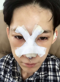 深圳廣和尹衛(wèi)民做的隆鼻整形，大家來看看果