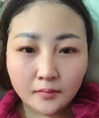 金子甘國(guó)端醫(yī)生給我做完高強(qiáng)度聚焦超聲之后皮膚緊致多了