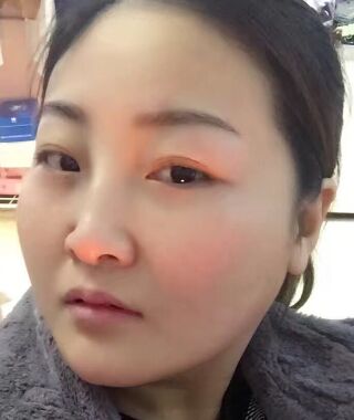 金子甘國(guó)端醫(yī)生給我做完高強(qiáng)度聚焦超聲之后皮膚緊致多了