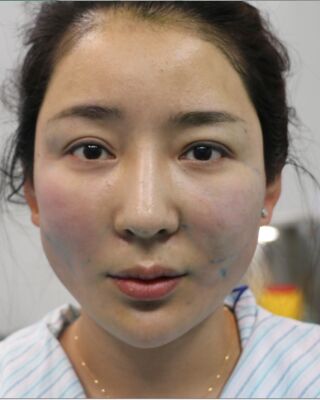 埋埋蛋白線.提升整個(gè)面部年輕很多，小V臉也出來(lái)了