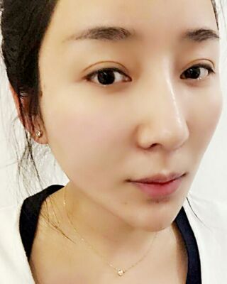 埋埋蛋白線.提升整個(gè)面部年輕很多，小V臉也出來(lái)了