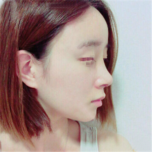 蔣醫(yī)生做的隆鼻失敗修復(fù)分享，還有前后對比果圖片哦~