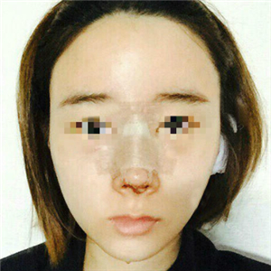 蔣醫(yī)生做的隆鼻失敗修復(fù)分享，還有前后對比果圖片哦~