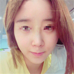 蔣醫(yī)生做的隆鼻失敗修復(fù)分享，還有前后對比果圖片哦~