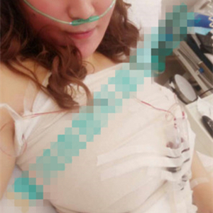 分享我自體脂肪隆胸手術(shù)前后對(duì)比照片，果不錯(cuò)哦~