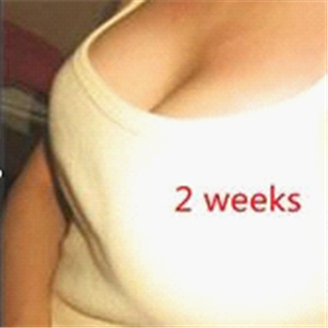 分享我自體脂肪隆胸手術(shù)前后對(duì)比照片，果不錯(cuò)哦~