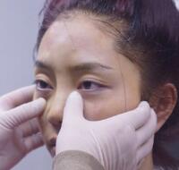 自體脂肪隆鼻、墊下巴、豐蘋果肌前后對比圖和恢復(fù)過程分享