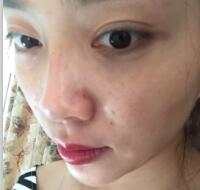 自體脂肪隆鼻、墊下巴、豐蘋果肌前后對比圖和恢復(fù)過程分享