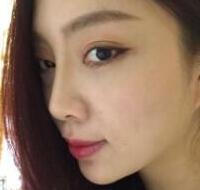 自體脂肪隆鼻、墊下巴、豐蘋果肌前后對比圖和恢復(fù)過程分享