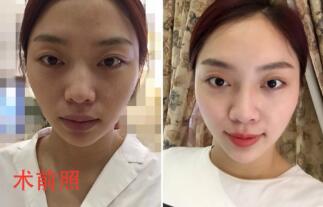 自體脂肪面部填充前術(shù)后對比照