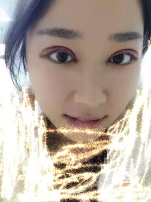 你們來看看翟爽做的切開雙眼皮怎么樣