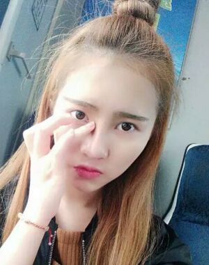 隆鼻整形果好到無法形容，廣州海峽軍做的