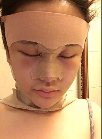 面部自體脂肪填充加隆鼻整形 讓我擁有一張網(wǎng)紅臉