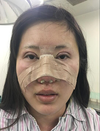 隆鼻整形雙眼皮開眼角讓我從屌絲逆襲成女神