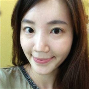 美女注射玻尿酸除皺過程分享，還有前后對比果圖片哦~