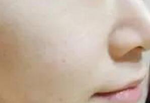 白瓷娃娃緩解一次后，皮膚能直觀看出來水潤白皙緊致了一些