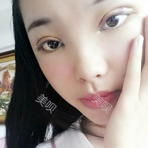 給大家分享下我割雙眼皮的恢復全過程希望對大家有幫助