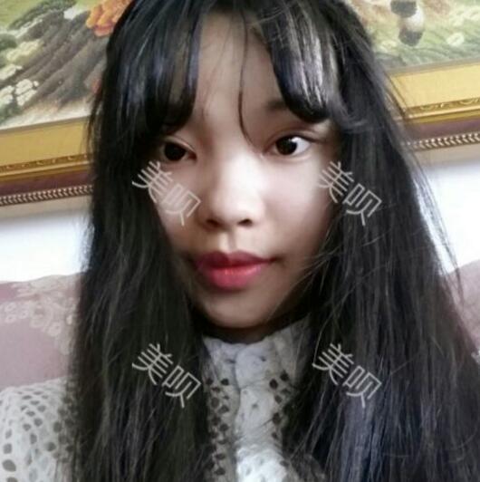 給大家分享下我割雙眼皮的恢復全過程希望對大家有幫助