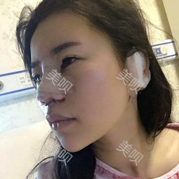 我的綜合隆鼻半個月的恢復歷程