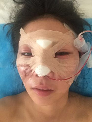 隆鼻手術前后過程對比圖，真實案例分享