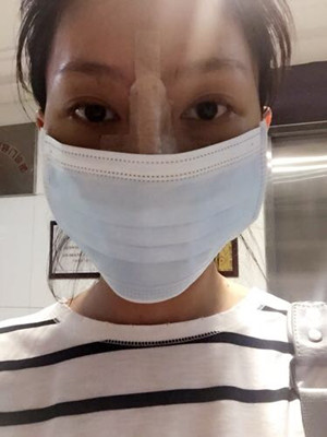 隆鼻手術前后過程對比圖，真實案例分享