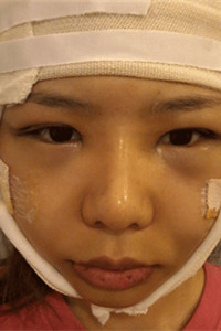 磨骨+下巴矯正手術前后過程(膽小勿入!)真實案例分享