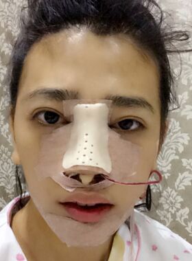 大鼻子做了隆鼻整形后終于變秀氣了
