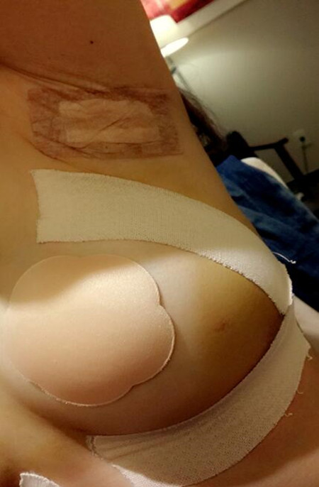 小胸和大胸就差一個李鴻君做的假體隆胸手術(shù)