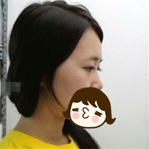 去年做的自體脂肪隆鼻手術(shù)，曬一下前后對比果圖片~