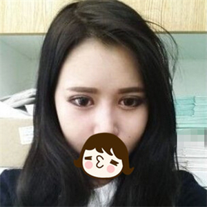 去年做的自體脂肪隆鼻手術(shù)，曬一下前后對比果圖片~