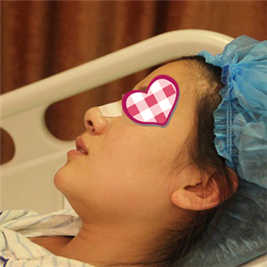 分享我自體軟骨隆鼻前后對比果圖片和恢復(fù)過程，在愛斯克做的哦~