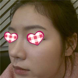 分享我自體軟骨隆鼻前后對比果圖片和恢復(fù)過程，在愛斯克做的哦~