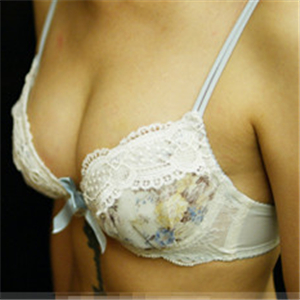 自體脂肪移植隆胸三個月了，分享恢復(fù)前后對比果照片~