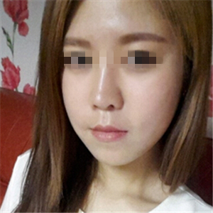 去年做了玻尿酸填充去法令紋，有前后對比果圖片哦~