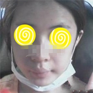 自體耳軟骨隆鼻手術(shù)恢復(fù)過(guò)程分享，還有前后對(duì)比果圖片哦~