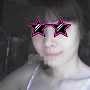 自體耳軟骨隆鼻手術(shù)恢復(fù)過(guò)程分享，還有前后對(duì)比果圖片哦~