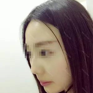 去年做了自體耳軟骨隆鼻手術(shù)，看看我的恢復(fù)過(guò)程照片，前后變化大~